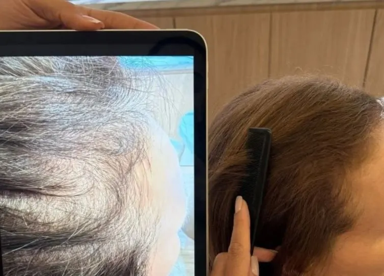 Avaliação da densidade capilar comparando áreas do couro cabeludo